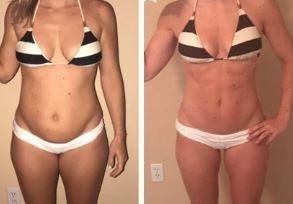 MYMI CurveBelly Wonder Patch