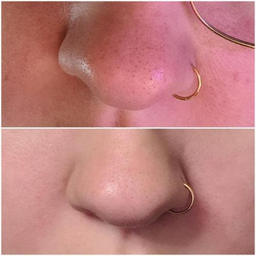 The Ordinary | AHA 30% + BHA 2% Peeling Solution