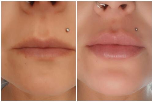 PoutPerfect | Lip Plumper