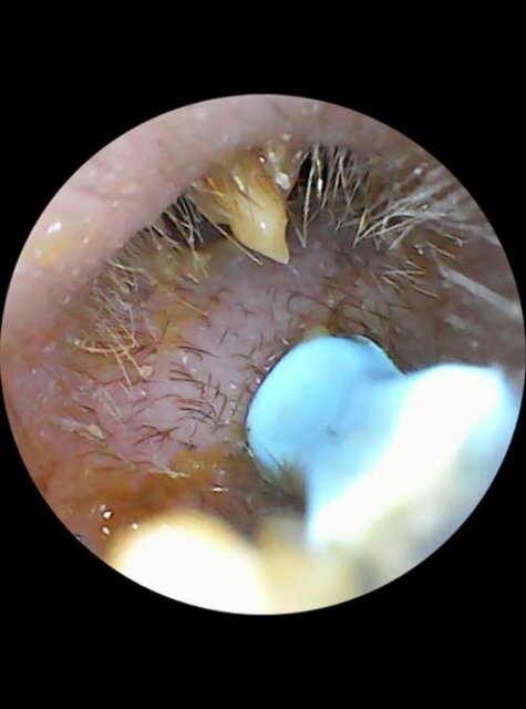 SmartScope Visual Ear Cleaner
