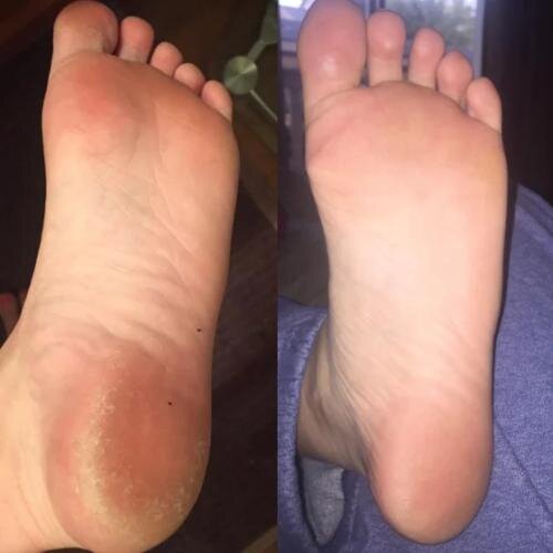 SmoothFeet Pro Electric Foot Callus Remover