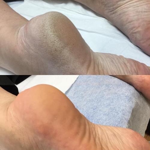 SmoothFeet Pro Electric Foot Callus Remover