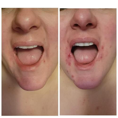 EpiGlowRadiance™: High Frequency Skin Therapy