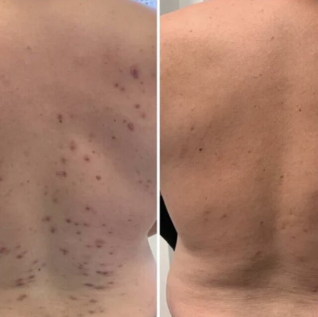 Produits Acne Out Bar