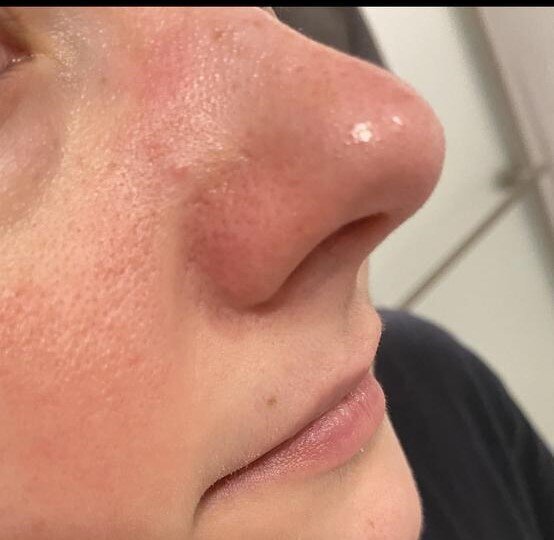 Dr.Melaxin Rice Peel Glow Serum Ampoule